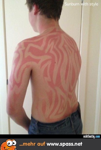 Wenn schon Sonnenbrand, dann richtig
